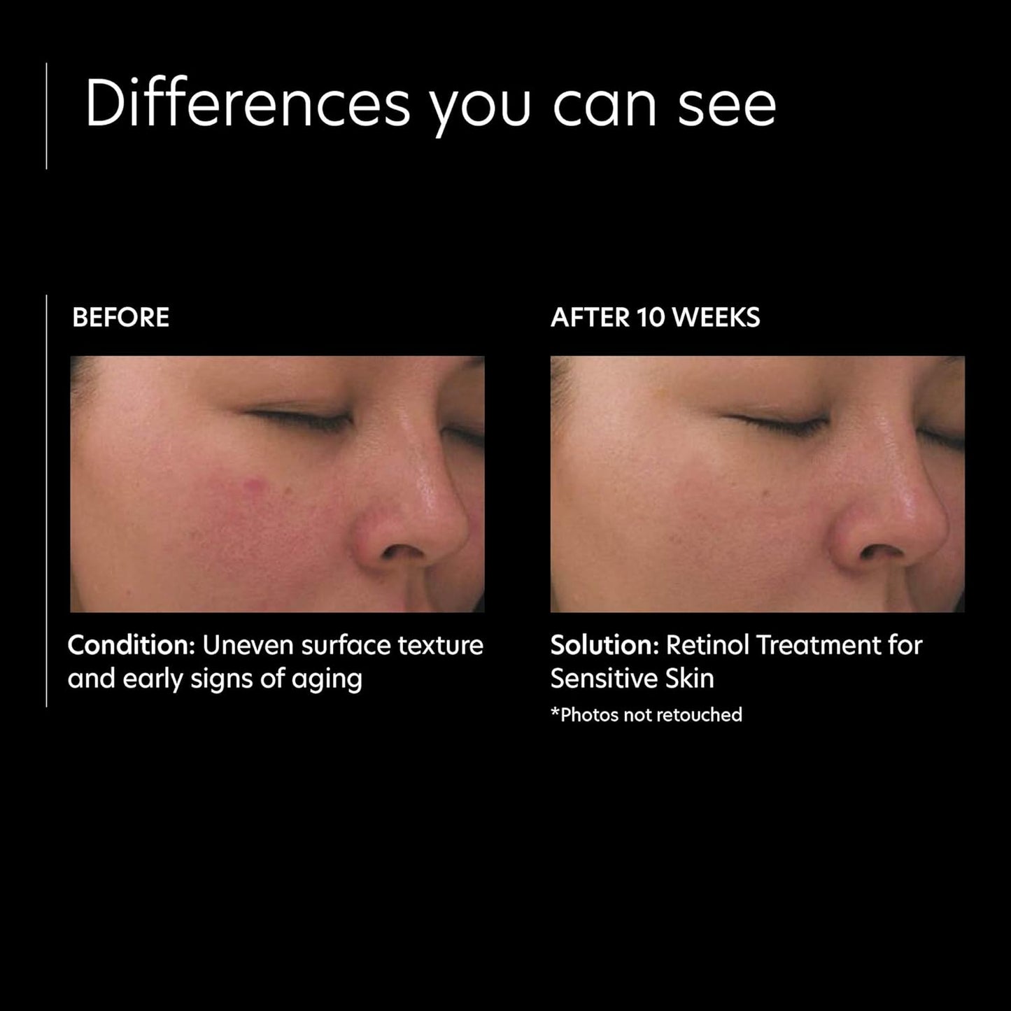 Dluxe Ave.PCA SKIN Retinol Treatment for Sensitive Skin - Anti Aging Face Serum to Gently Reduce Redness & Minimize Fine Lines & Wrinkles - Contains Vitamin A & Hydrating Niacinamide (1 oz)