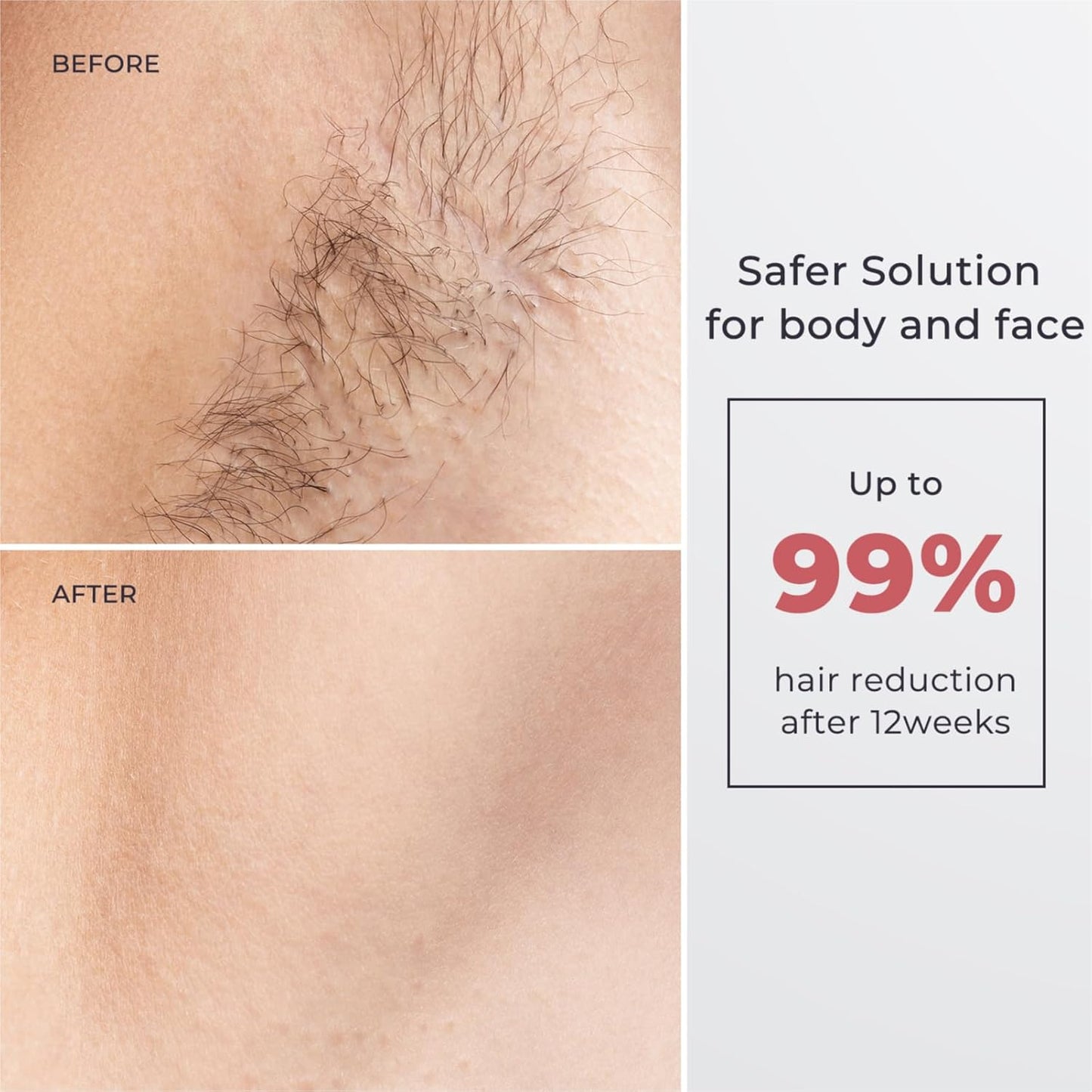 Dluxe Ave. Aopvui Laser Hair Removal for Women and Men IPL with Ice-Cooling System for Nearly Painless And Long-Lasting Result At-Home Permanent Hair Removal Device 999999 Flashes for Whole Body Use